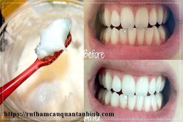 c&aacute;ch l&agrave;m trắng răng bằng baking soda nhanh ch&oacute;ng